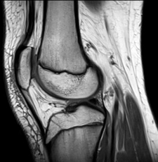 XRay of Knee Picture
